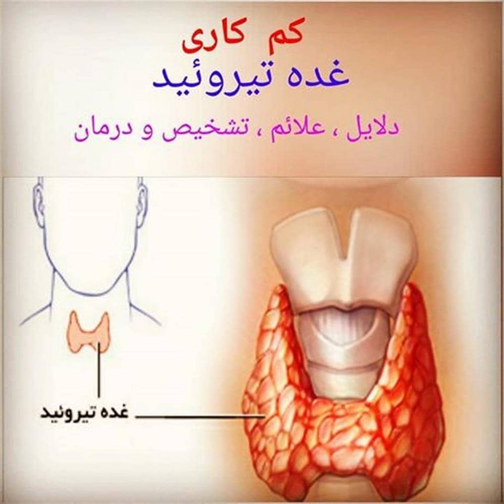 کمکاری تیروئید
